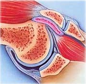 osteosarcoma